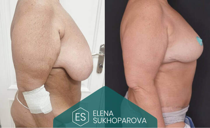 Пластика живота