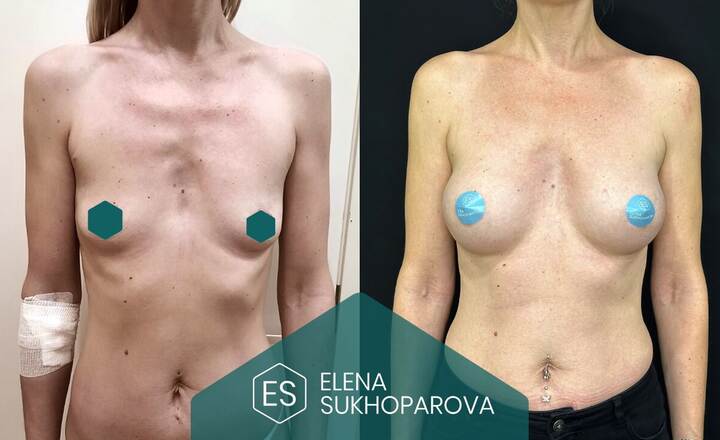 Увеличение груди