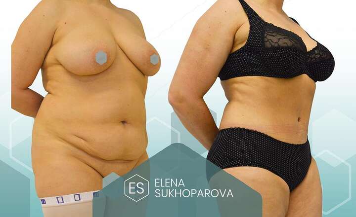 Пластика живота