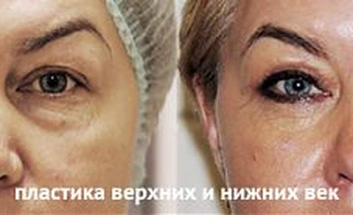 Блефаропластика и эндоскопия