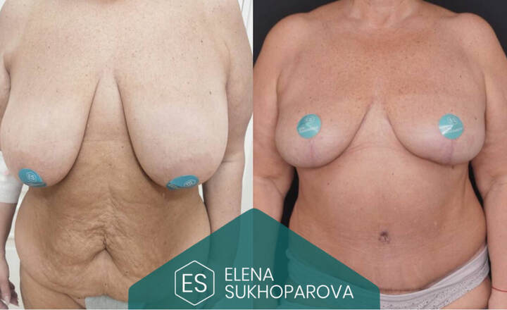 Пластика живота