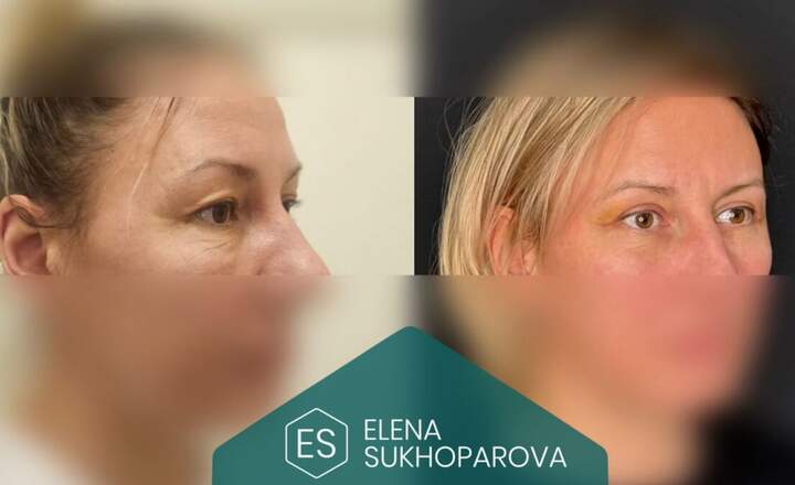 Блефаропластика и эндоскопия