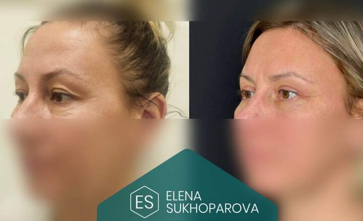 Блефаропластика и эндоскопия