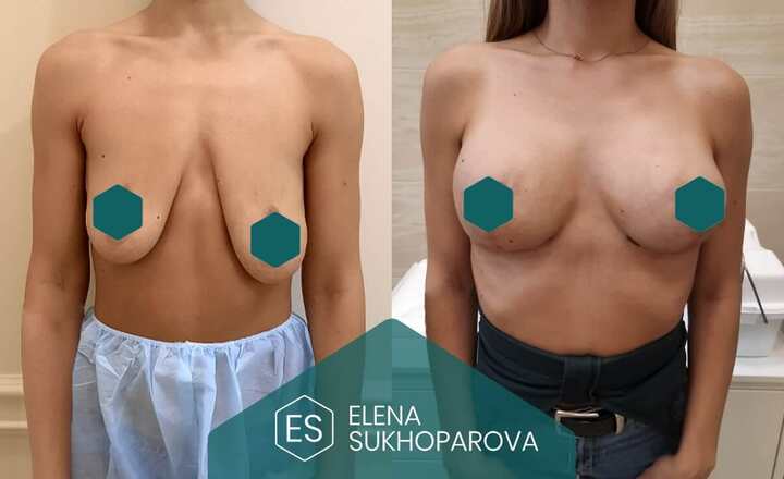 Подтяжка и уменьшение груди