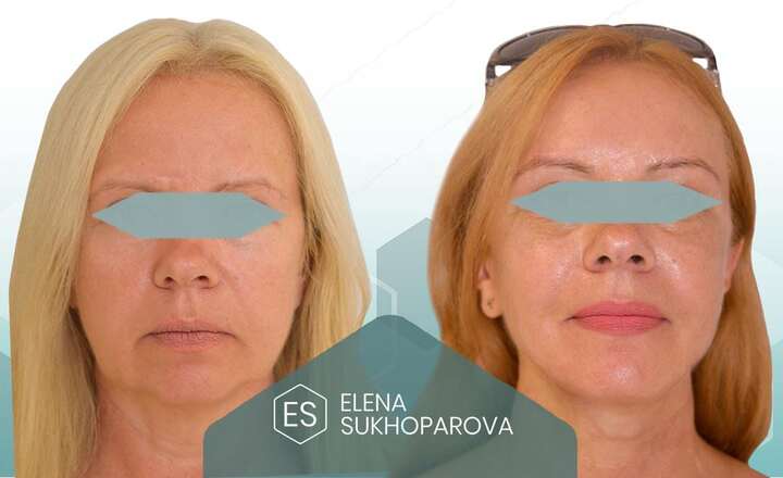 Подтяжка лица