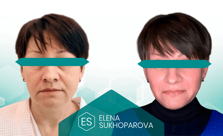Подтяжка лица