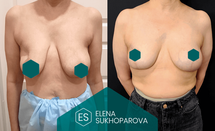 Подтяжка и уменьшение груди
