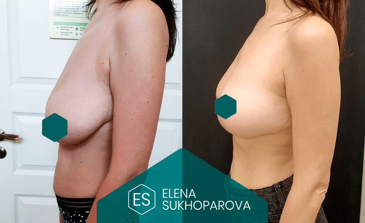 Подтяжка и уменьшение груди