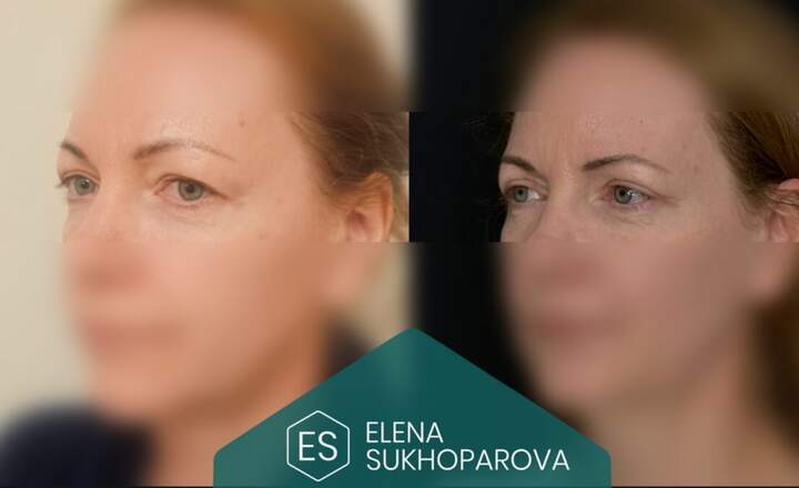 Блефаропластика и эндоскопия