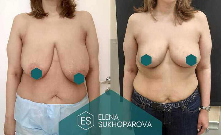 Подтяжка и уменьшение груди