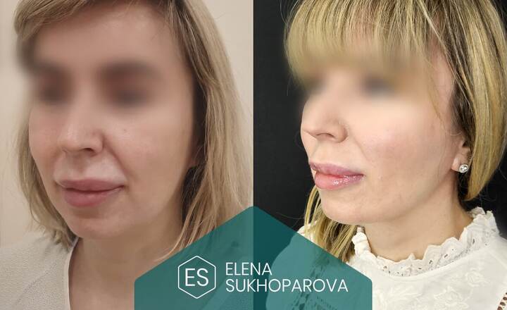 Подтяжка лица