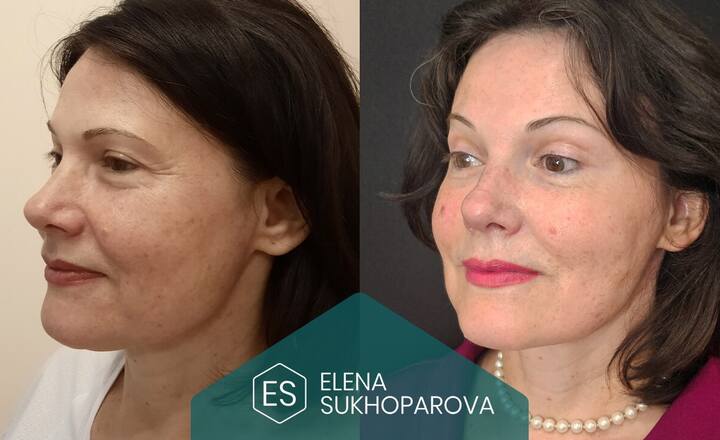 Подтяжка лица
