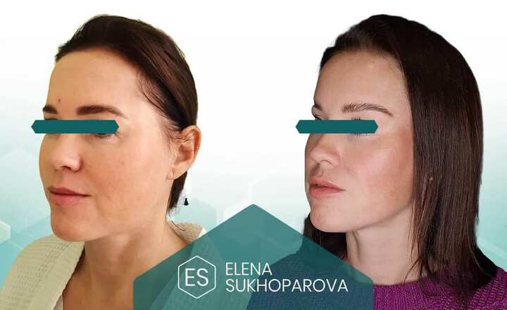 Подтяжка лица