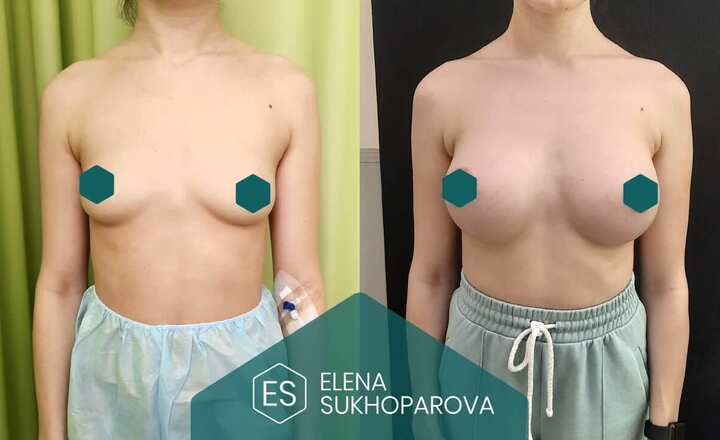 Увеличение груди