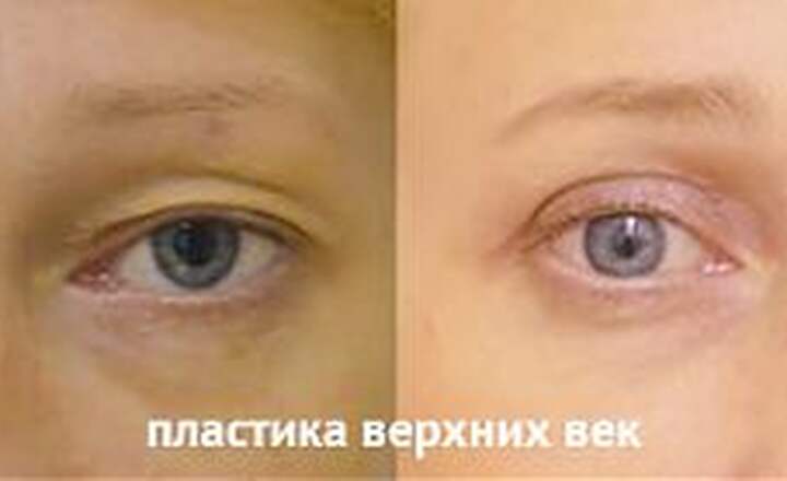 Блефаропластика и эндоскопия