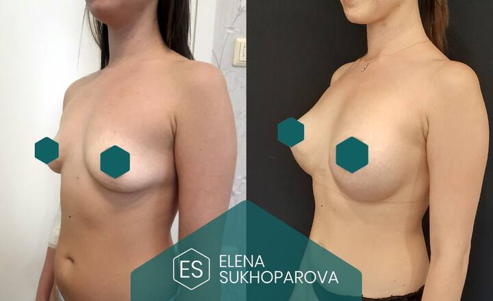 Увеличение груди