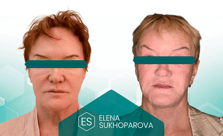 Подтяжка лица