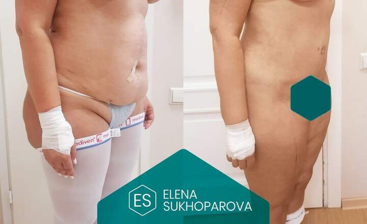 Пластика живота