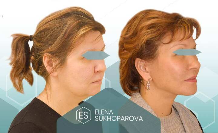 Липофилинг