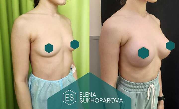 Увеличение груди
