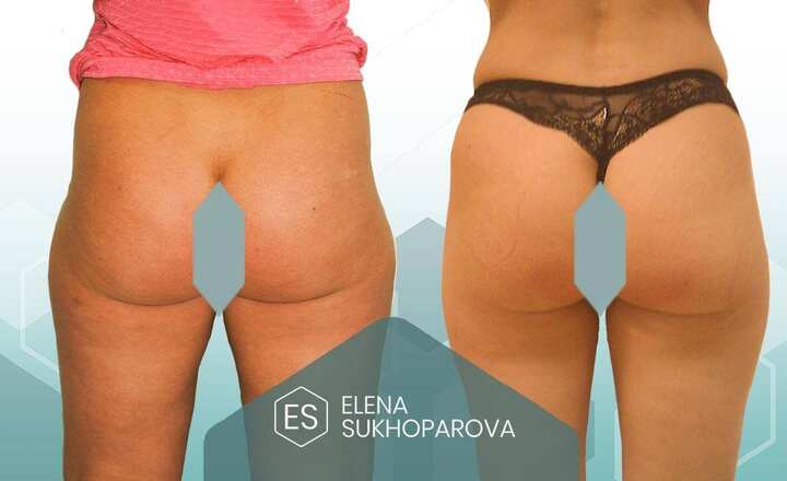 Липосакция