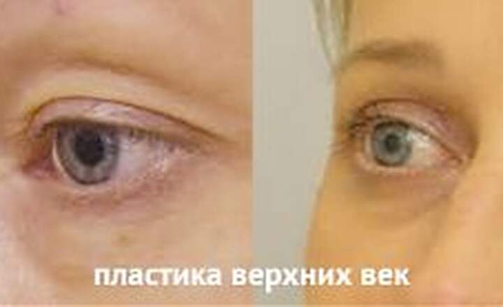 Блефаропластика и эндоскопия
