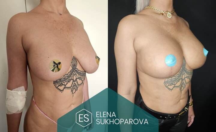 Подтяжка и уменьшение груди