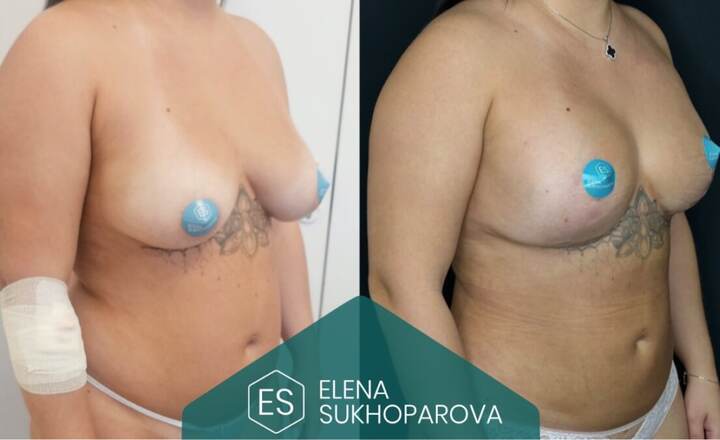 Липосакция