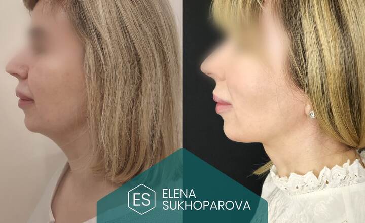 Подтяжка лица