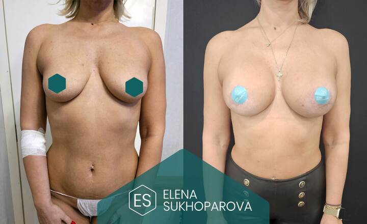 Увеличение груди