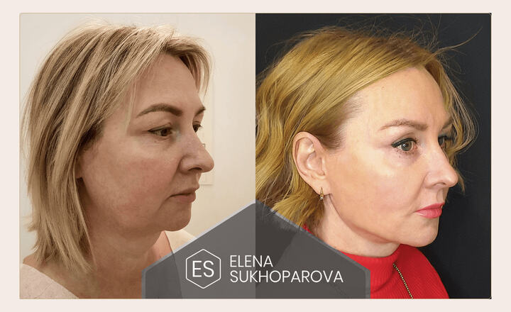 Подтяжка лица